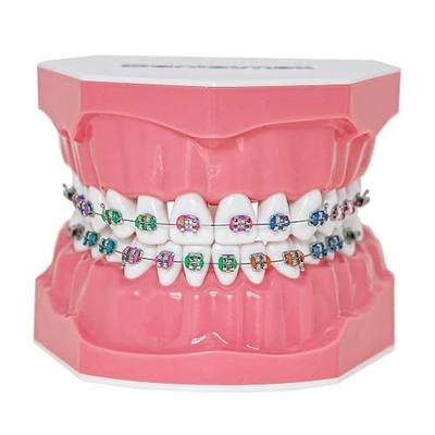Typodonts Orthodontics Demonstration Model with Metal Wires and Bracket Teaching, Learning, Interpretation Model for Adults and Children (Metal Bracket)