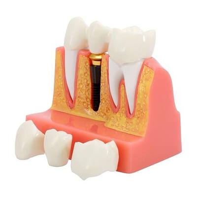 Annhua 4 Times Dental Implant Teeth Model Analysis Crown Bridge Demonstration Model, Dental Teeth Crown Roots Removable for Education, Patients Communication, Learning and Lab