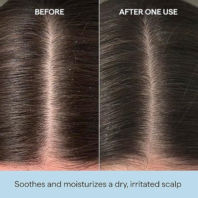 Briogeo Scalp Revival Rosemary Pre-Wash Oil | Moisturizing Scalp Treatment for Dry, Flaky, or Itchy Scalp | Strengthens Hair & Soothes Scalp | Vegan & Cruelty-Free