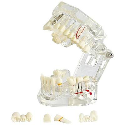 Transparent Dental Implant Model with Pathology for Educational Purposes - Demonstrative Implant Disease Teeth Model for Students and Professionals - Ideal for Dental Education and Demonstrations